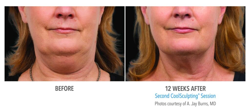 coolsculpting before after chin